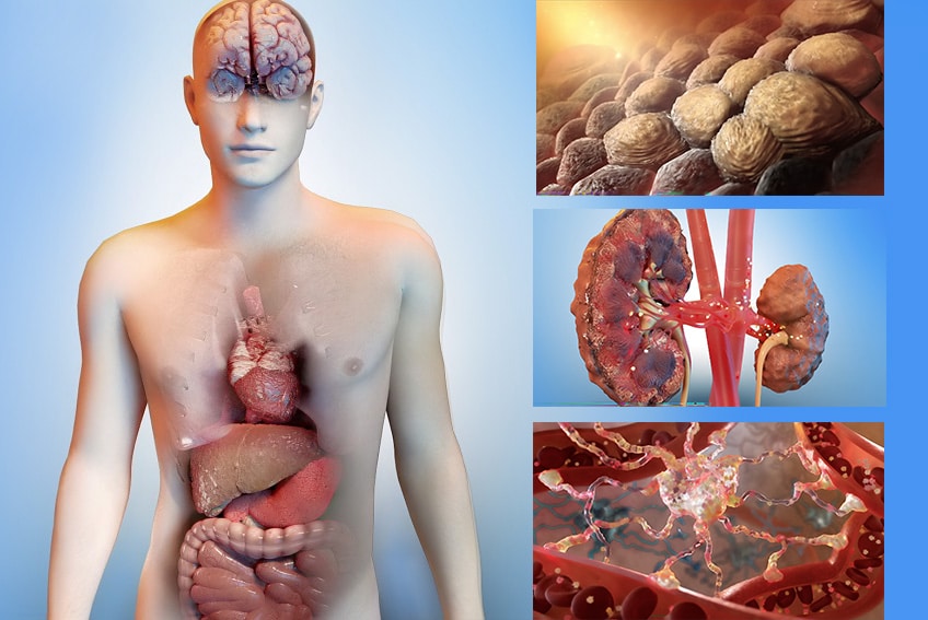 Image of ACLF and multiple organs failure